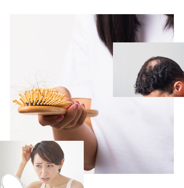 Three interlocked images of a three people showing hair loss.